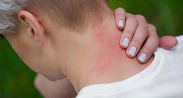 Natural anti-itch and soothing essence